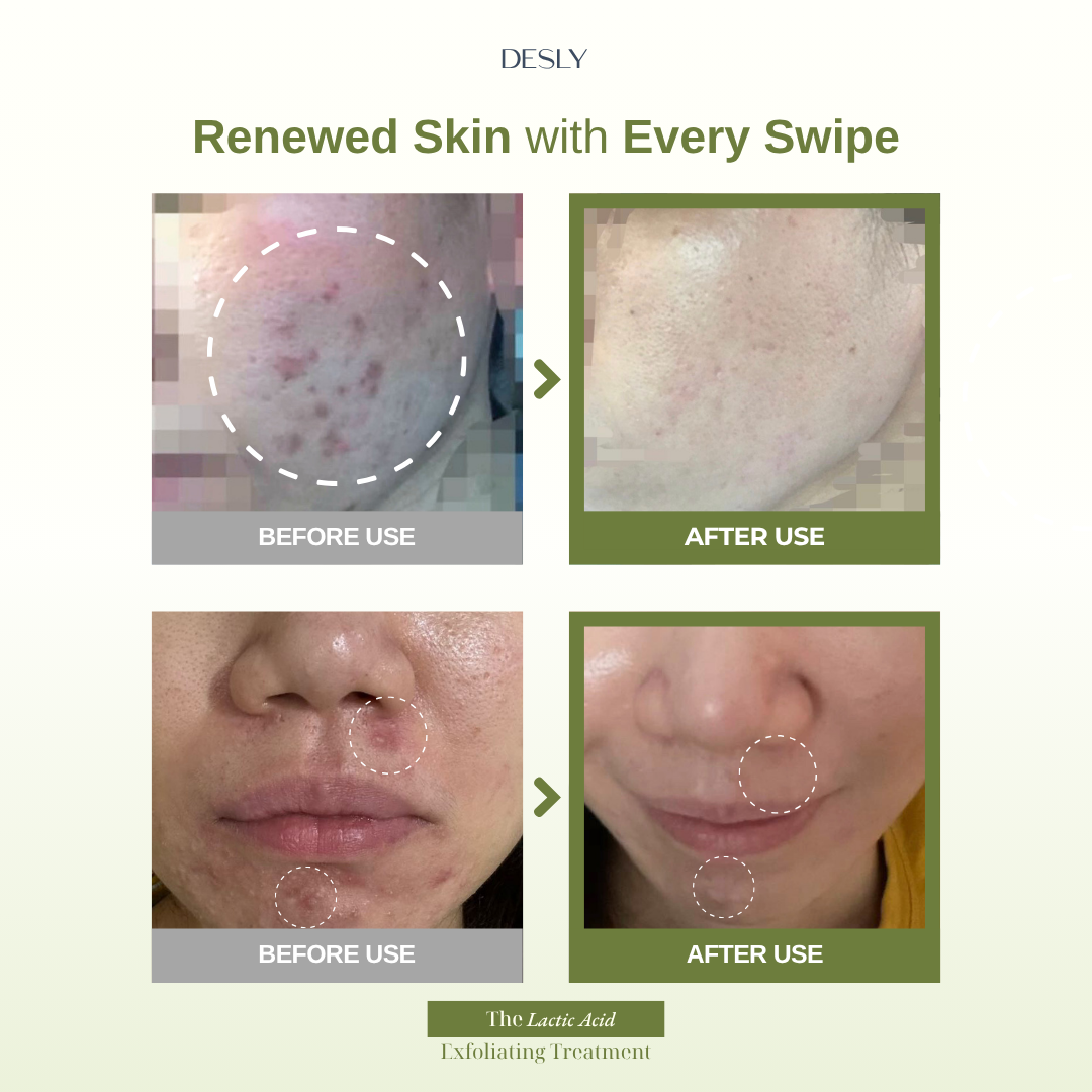 The Lactic Acid Exfoliating Treatment 30ml
