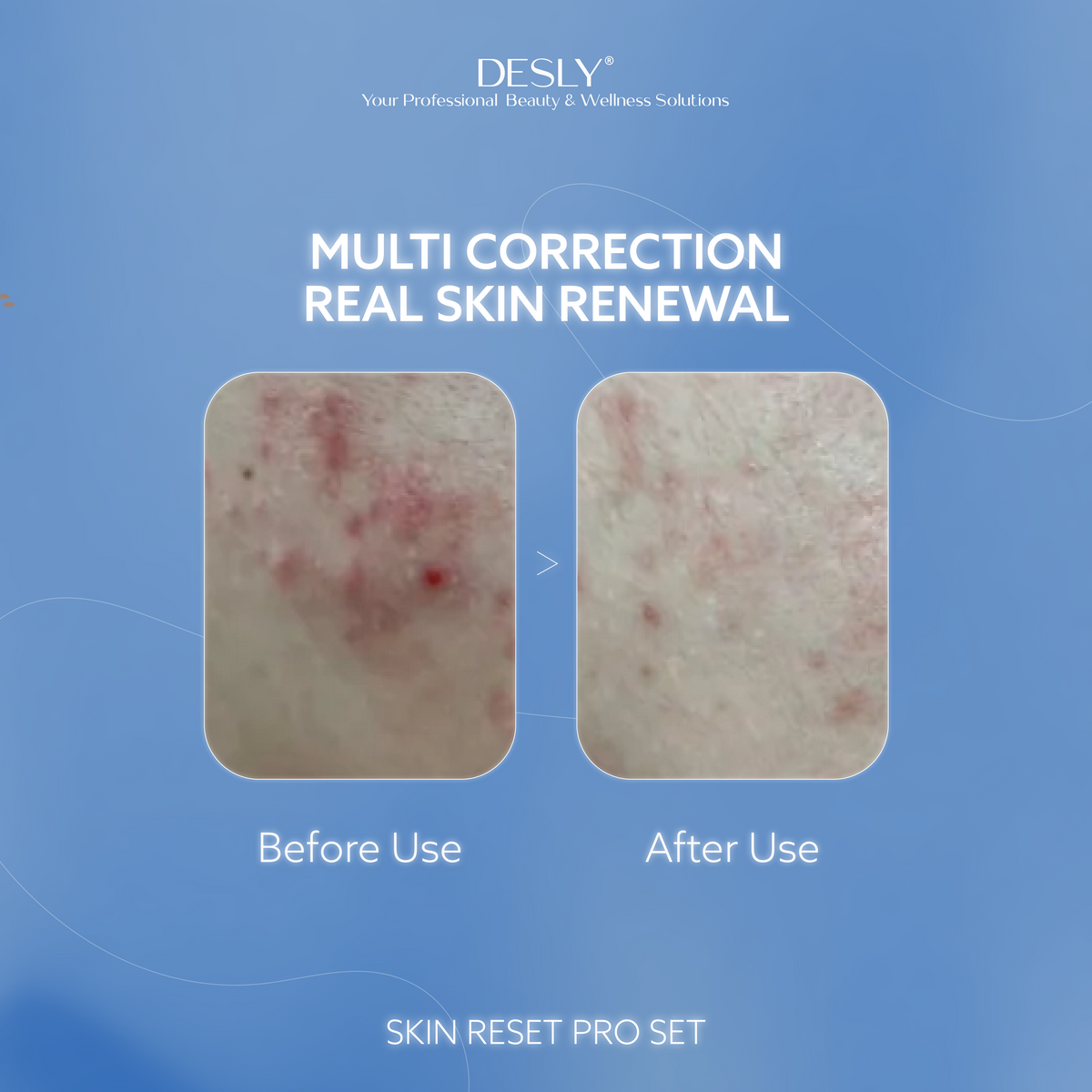 Skin Reset Pro Set